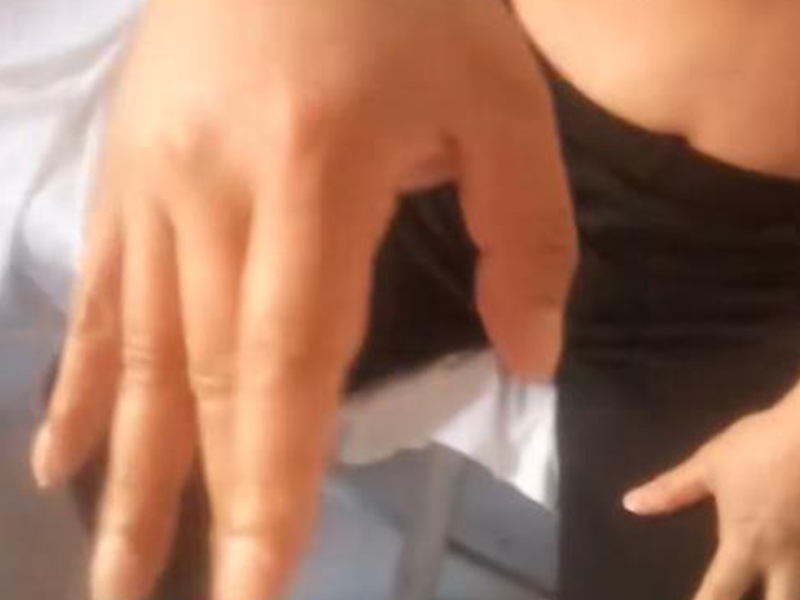 脑血栓挎框吴先生